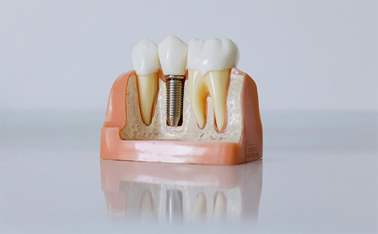 Zahnersatz mit Kronen, Brücken und Implantaten – hochwertige Zahnersatzlösungen in der ACC Zahnklinik Basel