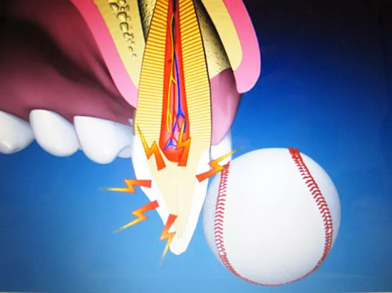 Ball trifft Schneidezahn und verursacht Lockerung oder Verschiebung – Zahnunfall-Behandlung in der ACC Zahnklinik Basel