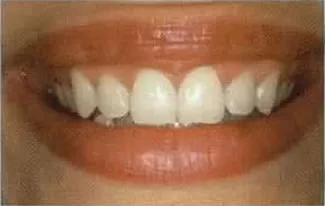 Nachher-Bild In-Office Bleaching – sichtbar aufgehellte Zähne nach professioneller Zahnaufhellung in der ACC Zahnklinik Basel