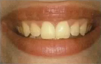 Vorher-Bild In-Office Bleaching – professionelle Zahnaufhellung für ein strahlendes Lächeln in der ACC Zahnklinik Basel