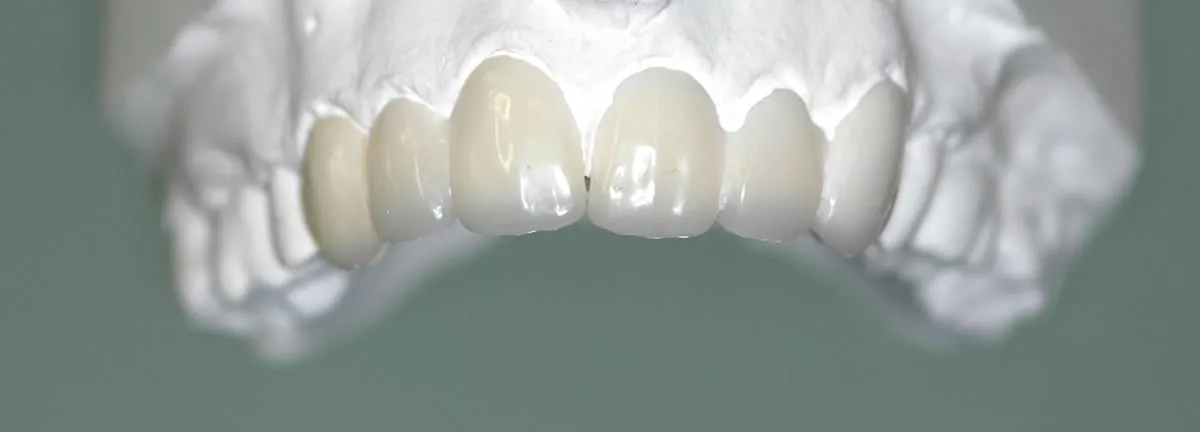 Moderne ästhetische Zahnfüllungen – natürlich wirkende und funktionale Füllungslösungen in der ACC Zahnklinik Basel