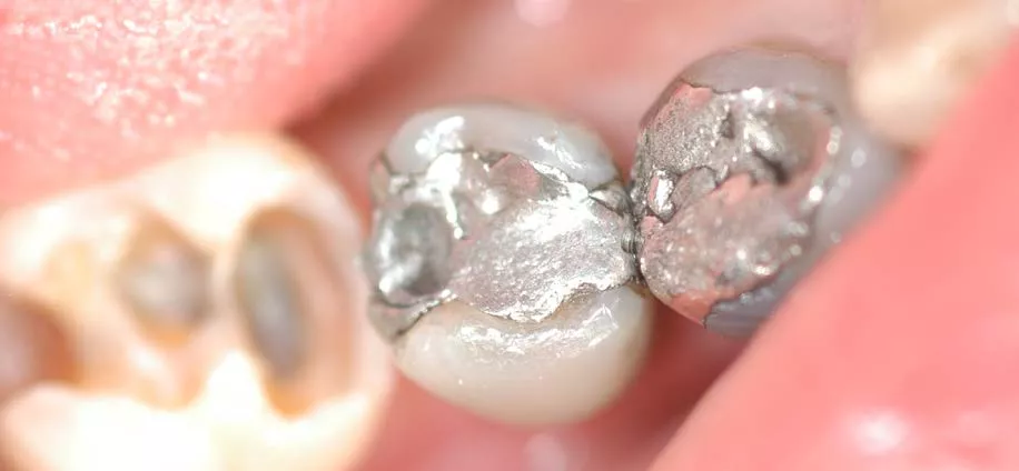 Amalgamfüllungen im Seitenzahnbereich – langlebige, aber überholte Füllungsmaterialien im Fokus der modernen Zahnmedizin der ACC Zahnklinik Basel