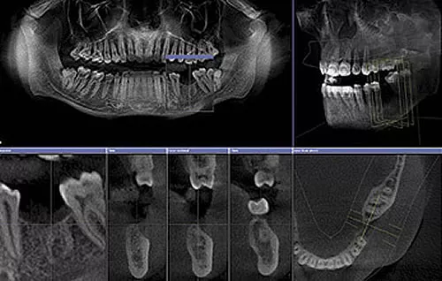 Digitale Volumentomographie (DVT) – 3D-Röntgendiagnostik für exakte Einblicke in den Kiefer bei der ACC Zahnklinik Basel