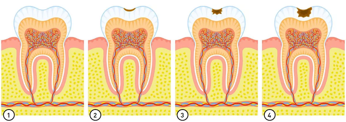 Kariesbehandlung im Überblick: Kariesstadien 1 bis 4 – frühzeitige Diagnose verhindert aufwändige Wurzelkanalbehandlungen in der ACC Zahnklinik Basel