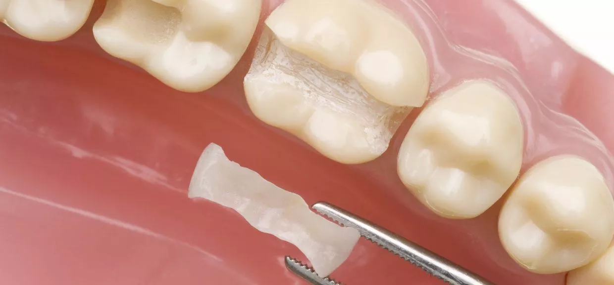 Moderne Kompositfüllung als ästhetische Alternative zu Amalgam – biokompatibler Füllungsersatz in der ACC Zahnklinik Basel