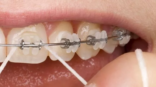 Lingualtechnik – unsichtbare Zahnspangen von innen befestigt für diskrete Kieferorthopädie in der ACC Zahnklinik Basel