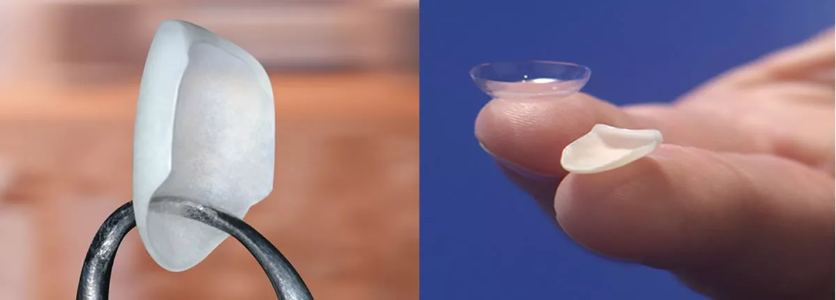 Lumineers – ultradünne, ästhetische Porzellanschalen als sanfte Alternative zu Veneers in der ACC Zahnklinik Basel