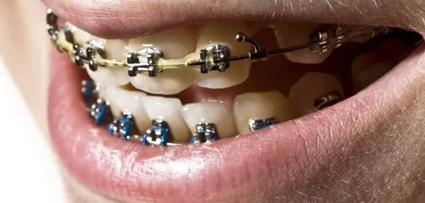 Multibracket-Apparaturen als festsitzende Zahnspangen – Kieferorthopädische Grundversorgung in der ACC Zahnklinik Basel