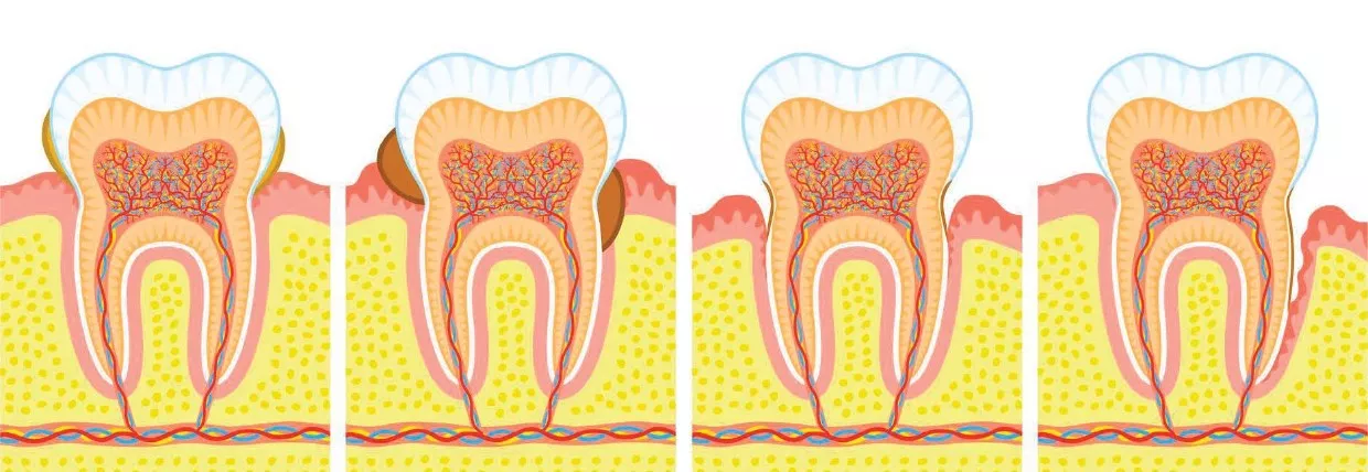 Parodontitis: entzündlicher Rückgang des Zahnfleischs – frühzeitige Diagnose und Behandlung in der ACC Zahnklinik Basel