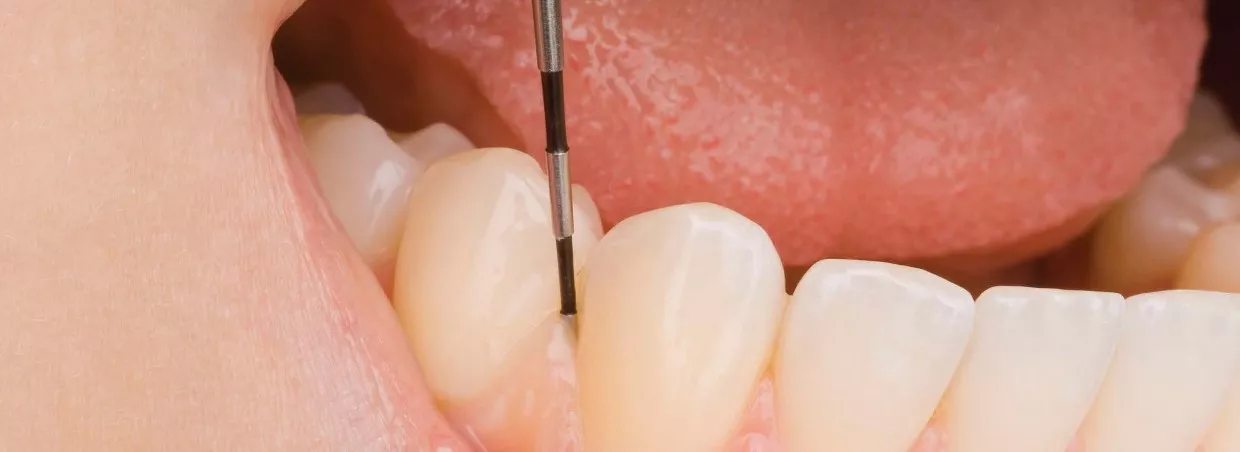 Taschentiefenmessung zur Diagnose und Verlaufskontrolle von Parodontitis – präzise Parodontaldiagnostik in der ACC Zahnklinik Basel