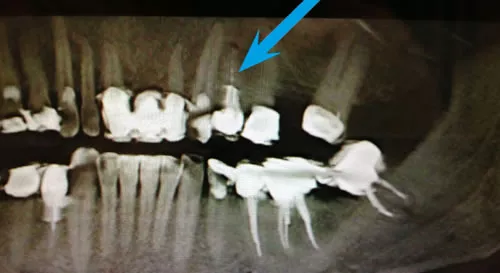 Zweidimensionales Röntgenbild der Zähne – Limitierungen der 2D-Röntgendiagnostik erklärt in der ACC Zahnklinik Basel