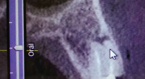 3D-Röntgen (DVT) für präzise Zahn- und Kieferdiagnostik – moderne Bildgebung in der ACC Zahnklinik Basel