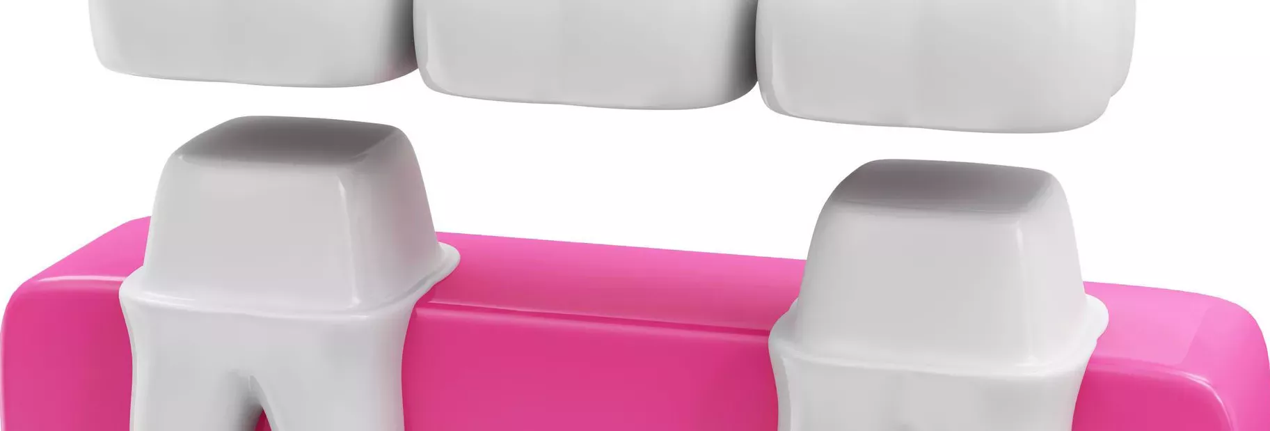 Zahnbrücke – festsitzender Zahnersatz zum Schließen von Zahnlücken in der ACC Zahnklinik Basel