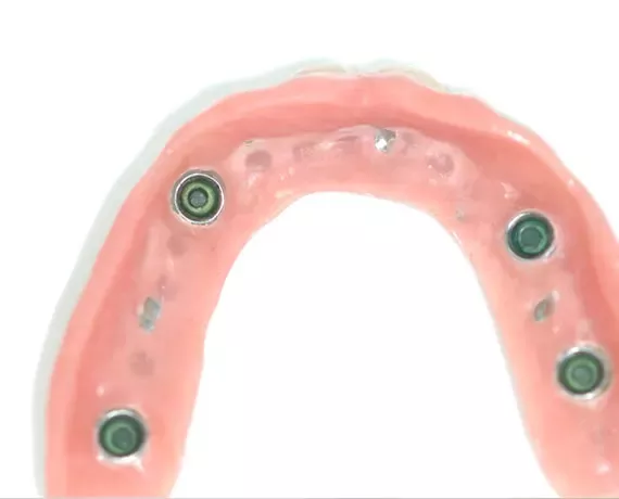 Klammerfreie Hybridprothese – ästhetischer und komfortabler Zahnersatz ohne sichtbare Halteklammern in der ACC Zahnklinik Basel