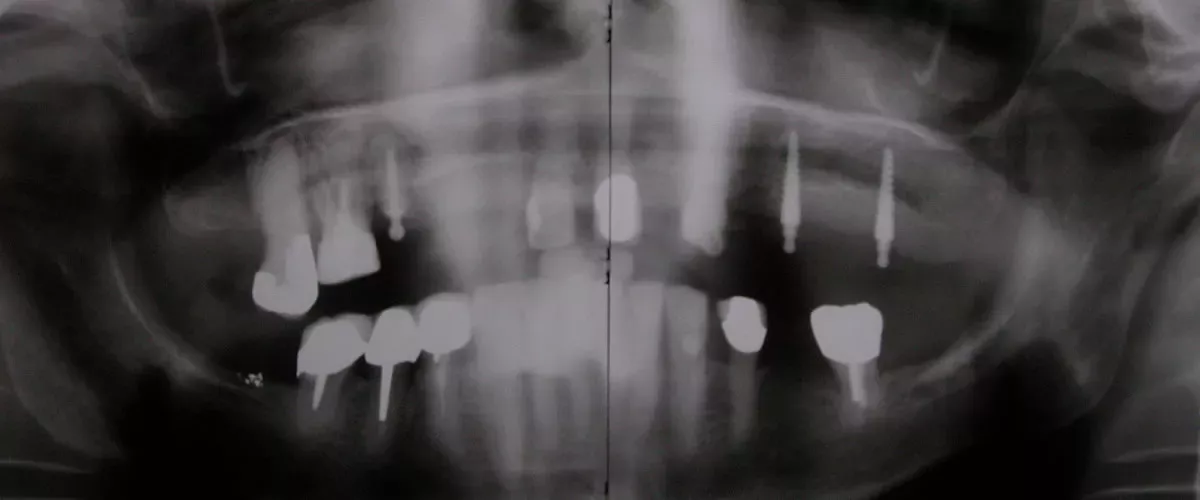 Zwei Mini-Implantate als provisorische Versorgung – temporäre Implantatlösung in der ACC Zahnklinik Basel