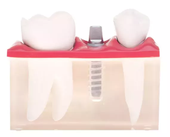 Titanimplantat – stabile und langlebige Implantatlösung für festen Zahnersatz in der ACC Zahnklinik Basel