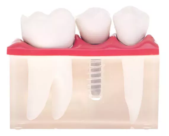 Titanimplantat – stabile und langlebige Implantatlösung für festen Zahnersatz in der ACC Zahnklinik Basel